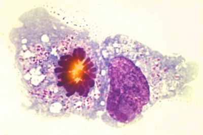 Krebszelle in Teilung